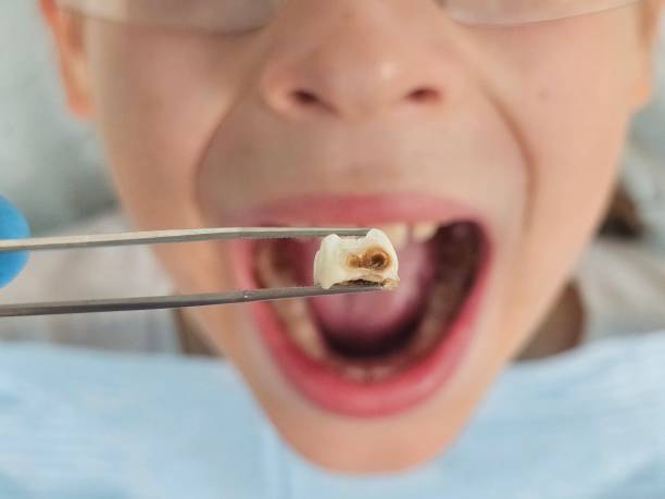 Best Emergency Wisdom Teeth Removal in Golden Valley, MN